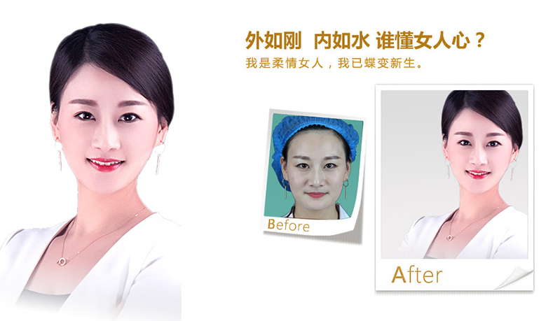 徐州V脸、线雕隆鼻